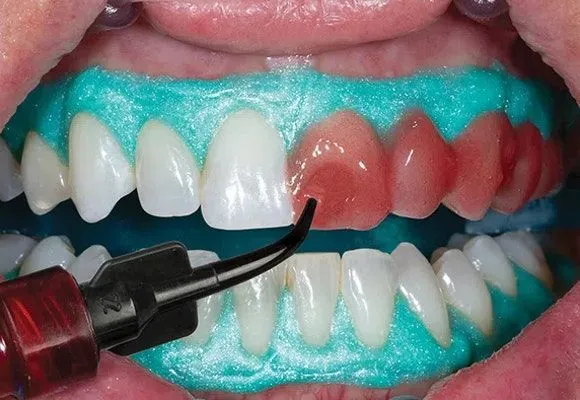 Bleaching Polishing